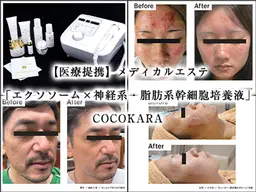 【結果重視】神経幹細胞導入☆しみ、しわ、美白改善コース体験💆‍♀️✨️