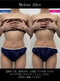 綺麗応援♥ プロ用シークレットメスマシンセルフエステ