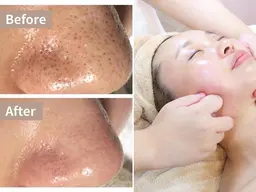 【毛穴/小顔ケア】本格小顔コルギ+全顔毛穴洗浄ハイドラ60分¥5500