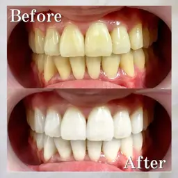 【当日限定】美容day白い歯になりたい方❣️時短🌟痛くない🦷ホワイトニング8分×2(通常￥8800