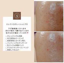 エレクトロポレーション　毛穴改善