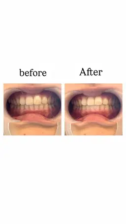 ✨️🦷セルフホワイトニング🦷✨️イベント前の方必見👀