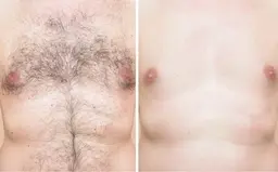 【男性】脇・胸・お腹・腕・脚・背中から1時間脱毛し放題