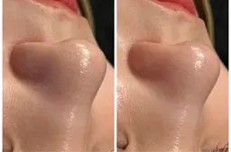 【毛穴洗浄】毛穴汚れに悩んでやませんか？ビタミンパックで毛穴レス！