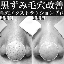 【8月ミニモ限定8,800円✨】毛穴エクストラクション　毛穴の黒ずみやざらつき改善×ビフォアフ撮影OKの方限定🎁