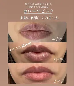 話題の最新黒ずみ除去【ローマピンク・唇】　　　　　　　　モニター募集中！！40%オフ
