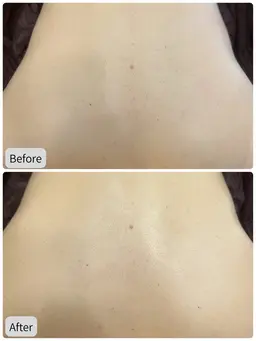 【特別価格!】背中美肌ケア★ハーブピーリングでツル肌をGET