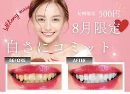 【8月限定】強力！歯のセルフホワイトニング（9分2セット）1回3980円→500円
