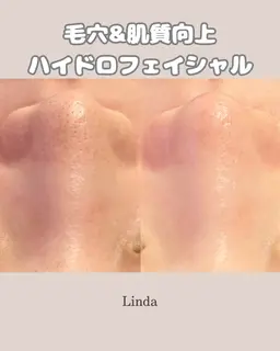 【鼻のみ】毛穴詰まり・黒ずみざらつき徹底ケア☆毛穴洗浄