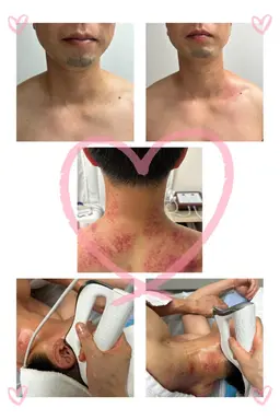 最新［インディバ+BIO筋膜リリース+ハンドリンパ］肩こり、首、腰、みくみ⭐️上半身to下半身選べる
