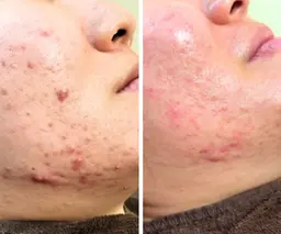 炎症ニキビ鎮静ケア