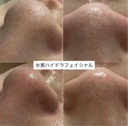 【8/22​〜​31までに来店できる方のみ✨❤️】水素ハイドラフェイシャルフルコース🫶🏻✨