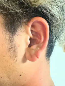 耳つぼ 両耳20粒まで