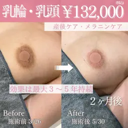 色素沈着・メラニン除去🫧ローマピンク40%OFF【バスト】アフタークリーム3本プレゼント🎁実質60%相当!