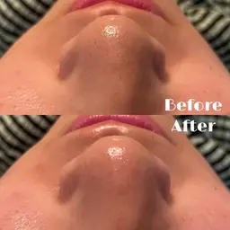 【毛穴ゼロ肌へ】水光洗浄×美白ケア✨〈90分〉 ¥0