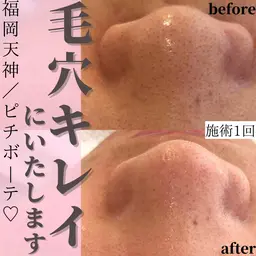 毛穴モデル募集❣️【8月限定】¥9750→¥0!毛穴の黒ずみ、毛穴詰まり解消✨毛穴洗浄ハイドラピールコース