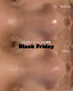【ブラックフライデー限定】ハーブ×毛穴吸引￥12000