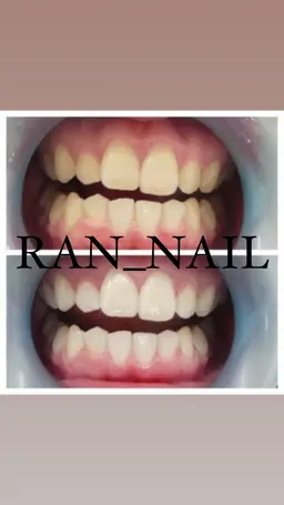 セルフホワイトニング🦷