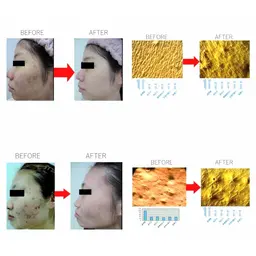 ◆ご新規様限定◆人気No.1【ニキビ全6種類対応アクネケア】パーソナライズケア