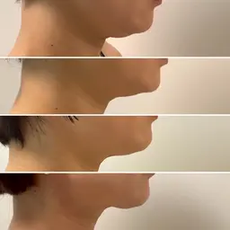 脂肪吸引はまだ早い！ダウンタイムなし！痛みなし！大人気の二重顎、口横のポニョ撃退！脂肪細胞のサイズを小さくする施術です