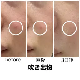 【ニキビ・ニキビ跡に！】次世代ハーブピーリングで本気の肌改善✨すっぴんでも自信の持てるお肌へ♡剥離なし、ダウンタイムなし