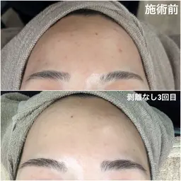 【顔ハーブピーリング】毛穴、シミ、ニキビ★剥離あり・なし選択可★※Google口コミ必須