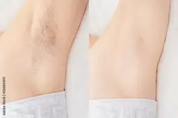 女性、脇脱毛！
