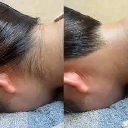 《挙式やヘアアップに》うなじワックス脱毛