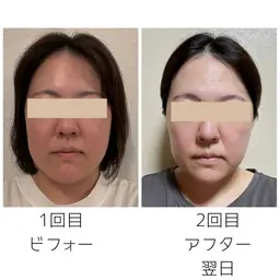 小顔矯正5回モニター　初回滞在約90分※注意事項を必読の上、ご予約ください