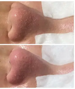 黒ずみさよなら！つるつる毛穴コース　いちご鼻もスッキリ！30分