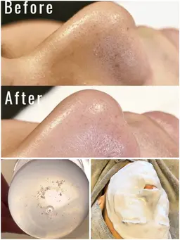 顔全体毛穴洗浄