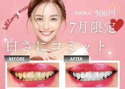 【7月限定】セルフホワイトニング9分×2セット［札幌/西区/琴似/ホワイトニング］