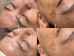 ⭐️🐦⬛BLACK FRIDAY🐦⬛⭐️ダウンタイムなし!!肌質改善イラストリアス美白ケア¥13,200