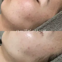 くすみ改善メニュー✨ハーブピーリング🌿
