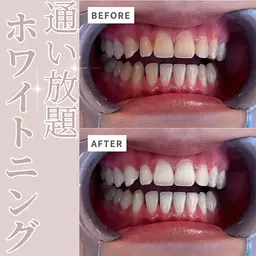 【定額★通い放題】セルフホワイトニング ¥11000/月