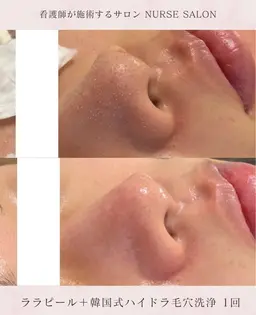 ⭐️12/6.9.14.17限定⭐️【全顔ピーリングパック+ハイドラ毛穴洗浄＋水光パック】一回で効果実感の声多数💡