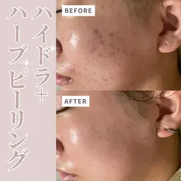 【即効性有💖肌質改善✨】水素ハイドラフェイシャル＋剥離なし✨ハーブピーリング🌿🇰🇷
