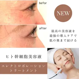 エレクトロポレーション〈ヒト幹細胞上清美容液〉