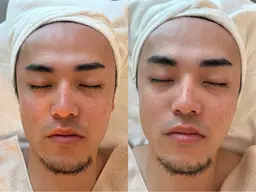 メンズ対象✨小鼻やおでこのざらつき解消✨肌検査+フェイシャルエステ+吸引機器＋余分な皮脂吸着モロッコクレイマスク🌿