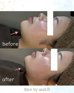 【内側からたるみにくいお肌へ☆】リフトアップフェイシャル（全顔）