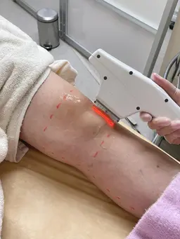 【平日限定】【IPL脱毛】 脚全体・指甲〜太もも脱毛