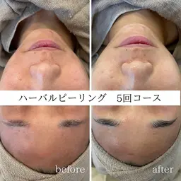 【毛穴/ニキビ•ニキビ跡に！本格肌質改善したいなら】リピーター様続出のハーブピーリングですっぴんツヤ肌を手に入れよう✨