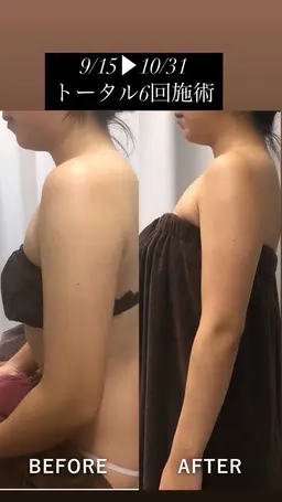 【二の腕スッキリ🔥70分】キャビ or 吸引＋深部ラジオ波▶︎ 気になる“振袖肉”を集中ケア/都度払い（モニター）