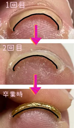 フット巻き爪ケア　親指1本