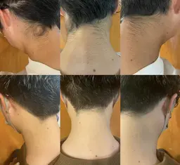 \3回目以降/Sパーツ脱毛【うなじ・脇・手指甲・足指甲・へそ周り】※ひとつ選択