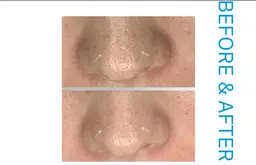 【濃厚美容成分】毛穴洗浄×リフトアップパックコース