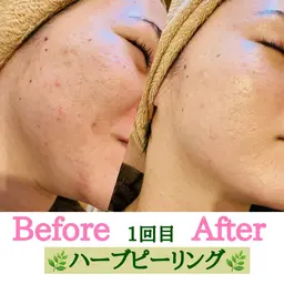 【剥離しないハーブピーリング🌿】安心安全の国産のハーブ使用で毛穴・ニキビ・たるみを改善❣️美白効果も◎