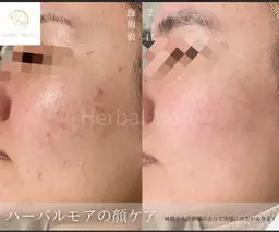 【根本改善】ハーバルモアピーリング✨剥離あり／ニキビ跡・毛穴ケア3回コース