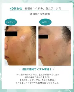 【フェイシャル人気Ｎｏ．1✨️】水光白玉フェイシャル 100分🫧