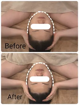 フェイシャルケア美容液導入込